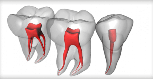 Root Canal Treatment: What to Expect?