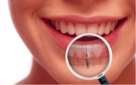 Learn Why Dental Implants the Best Way to Replace That Missing Tooth