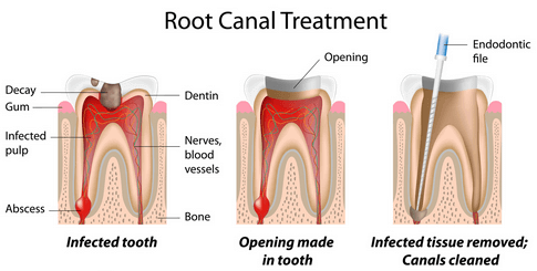 How To Avoid Root Canal Procedure And Pain