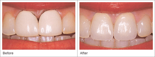 Need a New Porcelain One-hour Crown Right Now? Ask Us About CEREC