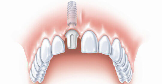 When Is It the Best Time to Get a Dental Implant?