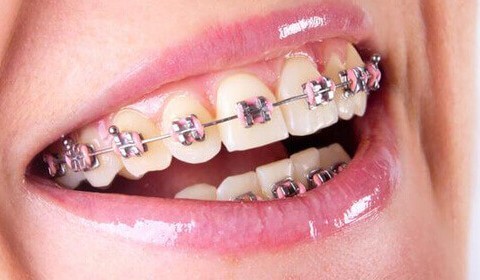 Are Dental Braces Effective and worth the Time and Effort?
