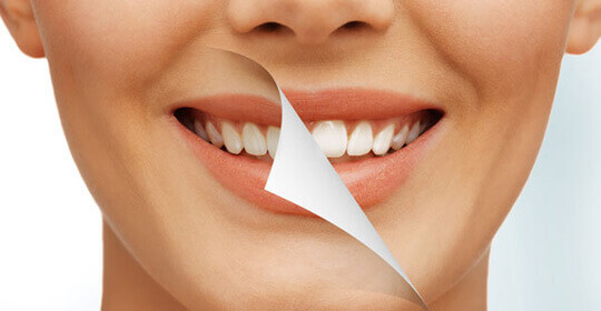 Teeth Whitening: Why It Is worth Considering