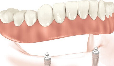 Missing All Your Lower Teeth? Ask about an Implant Overdenture