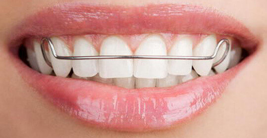 What Are Dental Retainers? Why Do I Really Need to Wear One?