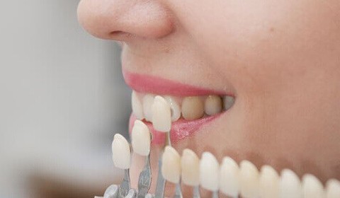 Have You Thought about Dental Veneers to Improve Your Smile?