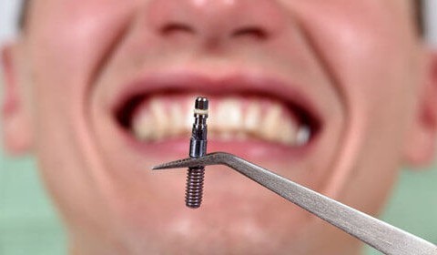 Dental Implant Surgery – Few Facts You Should Know